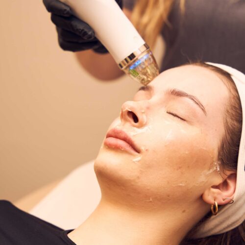 microneedling